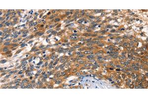 Immunohistochemistry of paraffin-embedded Human cervical cancer tissue using AGO1 Polyclonal Antibody at dilution 1:40 (AGO1 Antikörper)
