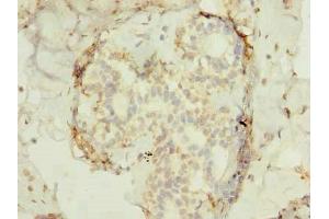 Immunohistochemistry of paraffin-embedded human breast cancer using ABIN7165522 at dilution of 1:100 (FAM53B Antikörper  (AA 1-305))