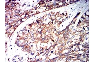 Immunohistochemical analysis of paraffin-embedded bladder cancer tissues using SERPINA1 mouse mAb with DAB staining. (SERPINA1 Antikörper  (AA 269-419))