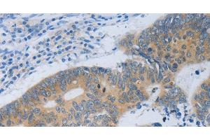 Immunohistochemistry of paraffin-embedded Human colon cancer tissue using MT2A Polyclonal Antibody at dilution 1:40 (MT2A Antikörper)