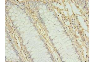 Immunohistochemistry of paraffin-embedded human colon cancer using ABIN7142391 at dilution of 1:100 (MRPL3 Antikörper  (AA 201-348))