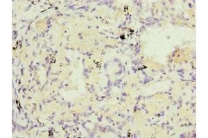 Immunohistochemistry of paraffin-embedded human lung cancer using ABIN7164323 at dilution of 1:100 (RARS2 Antikörper  (AA 17-340))