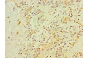 Immunohistochemistry of paraffin-embedded human breast cancer using ABIN7167784 at dilution of 1:100 (Retinoblastoma 1 Antikörper  (AA 649-928))