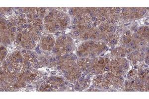 ABIN6273982 at 1/100 staining Human liver cancer tissue by IHC-P. (OR2T27 Antikörper  (Internal Region))