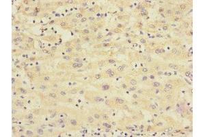 Immunohistochemistry of paraffin-embedded human liver cancer using ABIN7167664 at dilution of 1:100 (Relaxin 3 Receptor 1 Antikörper  (AA 1-80))