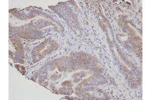 IHC-P Image Immunohistochemical analysis of paraffin-embedded human T(gastric cancer) , using NSMAF, antibody at 1:100 dilution. (NSMAF Antikörper)