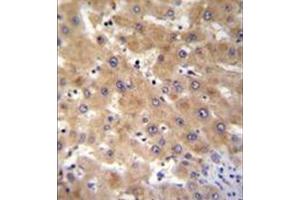 Immunohistochemistry analysis in formalin fixed and paraffin embedded human liver tissue reacted with GAGE12B Antibody (N-term) followed by peroxidase conjugation of the secondary antibody and DAB staining. (G Antigen 12B Antikörper  (N-Term))