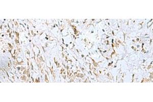 Immunohistochemistry of paraffin-embedded Human gastric cancer tissue using ECT2 Polyclonal Antibody at dilution of 1:35(x200) (ECT2 Antikörper)