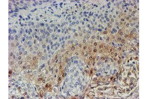 Immunohistochemical staining of paraffin-embedded Carcinoma of Human bladder tissue using anti-C17orf37 mouse monoclonal antibody. (C17orf37 Antikörper)