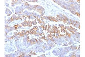 Formalin-fixed, paraffin-embedded human Colon Carcinoma stained with E-Cadherin Mouse Recombinant Monoclonal Antibody (rCDH1/1525).