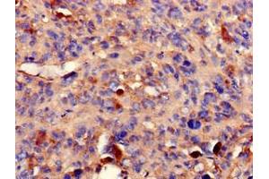 Immunohistochemistry of paraffin-embedded human melanoma using ABIN7169242 at dilution of 1:100 (PPP2R2A Antikörper  (Regulatory Subunit B))