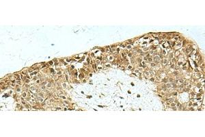 Immunohistochemistry of paraffin-embedded Human breast cancer tissue using KAT7 Polyclonal Antibody at dilution of 1:55(x200) (MYST2 Antikörper)