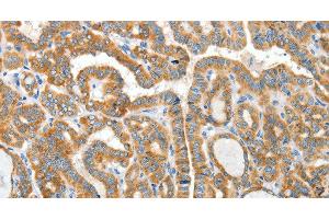 Immunohistochemistry of paraffin-embedded Human thyroid cancer using CKAP4 Polyclonal Antibody at dilution of 1:50