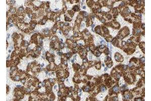 ABIN6268658 at 1/100 staining human liver cancer tissues sections by IHC-P. (PIK3CA Antikörper  (Internal Region))