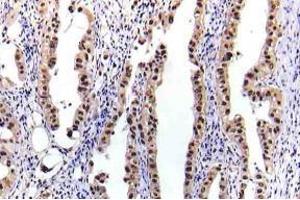 Immunohistochemistry (IHC) analyzes of p-STAT-5A antibody in paraffin-embedded human lung carcinoma tissue. (STAT5A Antikörper  (pSer780))