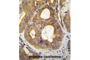 TRPM8 Antibody (N-term) immunohistochemistry analysis in formalin fixed and paraffin embedded human prostate carcinoma followed by peroxidase conjugation of the secondary antibody and DAB staining.