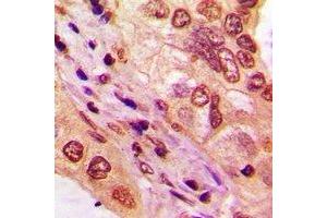 Immunohistochemical analysis of TBX10 staining in human lung cancer formalin fixed paraffin embedded tissue section. (T-Box 10 Antikörper)
