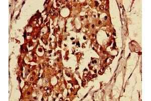 Immunohistochemistry of paraffin-embedded human breast cancer using ABIN7159021 at dilution of 1:100 (MAS1L Antikörper  (AA 318-378))