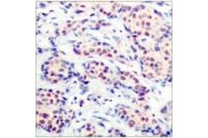 Immunohistochemistry analysis of paraffin-embedded human breast carcinoma tissue, using JunD (Ab-255) Antibody. (JunD Antikörper  (AA 222-271))