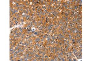 Immunohistochemical analysis of paraffin-embedded Human liver cancer tissue using at dilution 1/20. (FGF3 Antikörper  (C-Term))