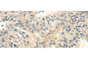 Immunohistochemistry of paraffin-embedded Human breast cancer tissue using CD70 Polyclonal Antibody at dilution 1:40 (CD70 Antikörper)