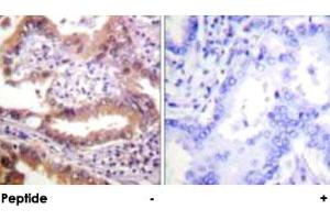 Immunohistochemical analysis of paraffin-embedded human lung carcinoma tissue using IRF3 polyclonal antibody . (IRF3 Antikörper)