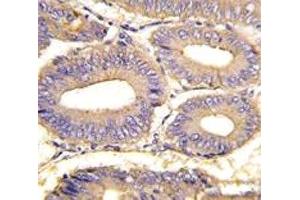 IHC analysis of FFPE human colon carcinoma tissue stained with PAK1 antibody (PAK1 Antikörper  (AA 401-430))