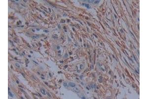 Detection of PLS3 in Human Colorectal cancer Tissue using Polyclonal Antibody to Plastin 3 (PLS3) (Plastin 3 Antikörper  (AA 379-630))