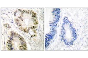 Immunohistochemical analysis of paraffin-embedded human colon carcinoma tissue using Cyclin E1 (phospho-Thr395) antibody. (Cyclin E1 Antikörper  (pThr395))