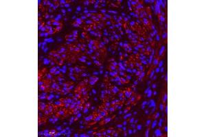 Immunofluorescence of paraffin embedded human cervical cancer using MYL6 (ABIN7074734) at dilution of 1:650 (400x lens) (MYL6 Antikörper)