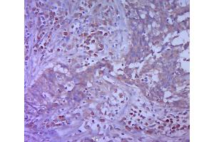 Paraformaldehyde-fixed, paraffin embedded human cervical cancer section; Antigen retrieval by boiling in sodium citrate buffer (pH6.