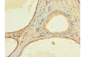 Immunohistochemistry of paraffin-embedded human prostate cancer using ABIN7176311 at dilution of 1:100 (ZNF432 Antikörper  (AA 1-260))