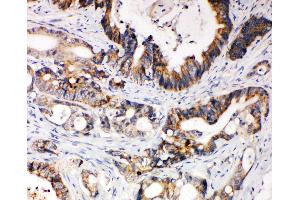 Anti-XIAP antibody, IHC(P) IHC(P): Human Intestinal Cancer Tissue (XIAP Antikörper  (N-Term))