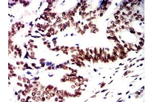 Immunohistochemical analysis of paraffin-embedded rectal cancer tissues using PMS2 mouse mAb with DAB staining. (PMS2 Antikörper)