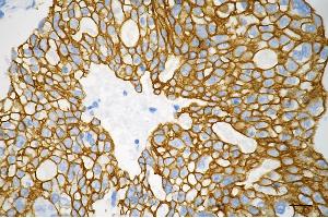 Immunohistochemistry was performed on paraffin-embedded human breast carcinoma using keratin 8 antibody (ABIN7799190), 1:200).