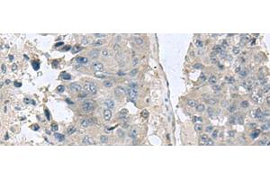 Immunohistochemistry of paraffin-embedded Human liver cancer tissue using NPHP1 Polyclonal Antibody at dilution of 1:60(x200) (NPHP1 Antikörper)