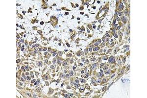 Immunohistochemistry of paraffin-embedded Human skin carcinoma using ICOSL Polyclonal Antibody at dilution of 1:100 (40x lens). (ICOSLG Antikörper)