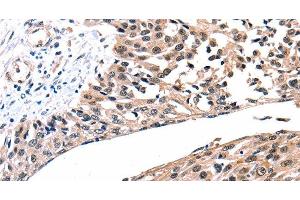 Immunohistochemistry of paraffin-embedded Human esophagus cancer tissue using Connexin-26 Polyclonal Antibody at dilution 1:100 (GJB2 Antikörper)