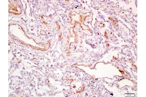 Formalin-fixed and paraffin embedded human lung carcinoma labeled with Anti-PDGF-D Polyclonal Antibody, Unconjugated (ABIN714581) at 1:200 followed by conjugation to the secondary antibody and DAB staining