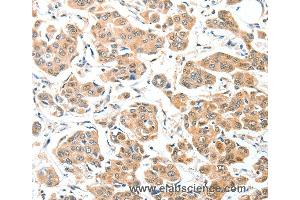 Immunohistochemistry of Human thyroid cancer using ADCK1 Polyclonal Antibody at dilution of 1:40 (ADCK1 Antikörper)