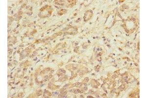 Immunohistochemistry of paraffin-embedded human pancreatic cancer using ABIN7173550 at dilution of 1:100 (Tropomodulin 1 Antikörper  (AA 1-359))