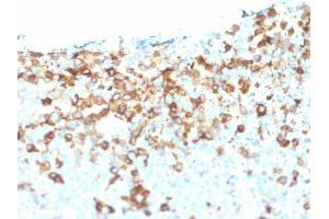 Formalin-fixed, paraffin-embedded human Melanoma stained with NGFR Mouse Monoclonal Antibody (NGFR/1964).