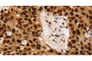 Immunohistochemistry of paraffin-embedded Human breast cancer using SSB Polyclonal Antibody at dilution of 1:30 (SSB Antikörper)
