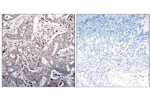 Immunohistochemical analysis of paraffin-embedded human breast carcinoma tissue, using IκB-β (Ab-23) antibody (E021304). (NFKBIB Antikörper)