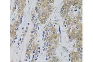 Immunohistochemistry of paraffin-embedded Human prostate cancer using DNM2 Polyclonal Antibody (DNM2 Antikörper)