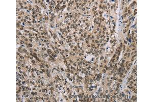 Immunohistochemistry of Human esophagus cancer using IRF9 Polyclonal Antibody at dilution of 1:50 (IRF9 Antikörper)