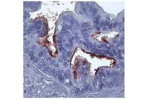 Immunohistochemistry (IHC) image for anti-Matrix Metallopeptidase 1 (Interstitial Collagenase) (MMP1) (N-Term) antibody (ABIN2777119)