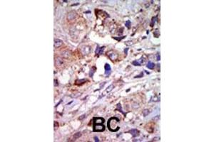 Formalin-fixed and paraffin-embedded human cancer tissue reacted with the primary antibody, which was peroxidase-conjugated to the secondary antibody, followed by AEC staining. (MAP3K12 Antikörper  (C-Term))