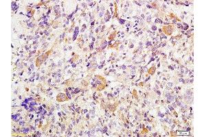 Formalin-fixed and paraffin embedded human osteosarcoma tissue labeled with Anti-Twist Polyclonal Antibody , Unconjugated at 1:200 followed by conjugation to the secondary antibody, (SP-0023), and DAB staining (TWIST1, TWIST2 (AA 71-170) Antikörper)