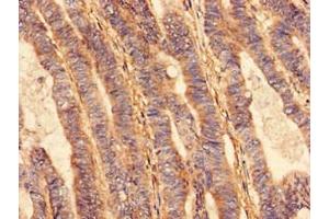 Immunohistochemistry analysis of human colon cancer using ABIN7175296 at dilution of 1:100 (VPS26B Antikörper  (AA 1-336))